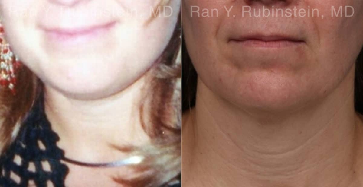 Laser Lift Precision Tx Before and After Photos in Newburgh, NY, Patient 19120