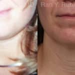 Laser Lift Precision Tx Before and After Photos in Newburgh, NY, Patient 19120