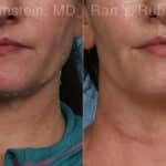 Genius Fractionated RF Before and After Photos in Newburgh, NY, Patient 21952