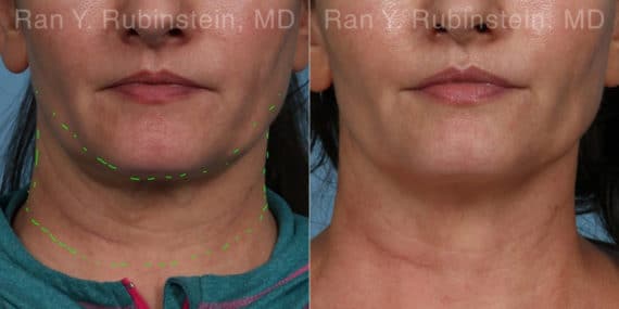 Skin Tightening Newburgh, NY, Non-Surgical Skin Treatment