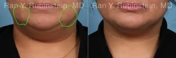 Buccal Fat Removal Before and After Photos in Newburgh, NY, Patient 22162