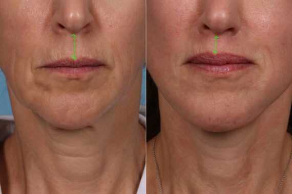 Face lift & Neck lift Before and After Photos in Newburgh, NY, Patient 22168