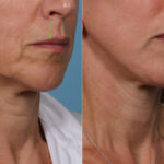 Face lift & Neck lift Before and After Photos in Newburgh, NY, Patient 22168