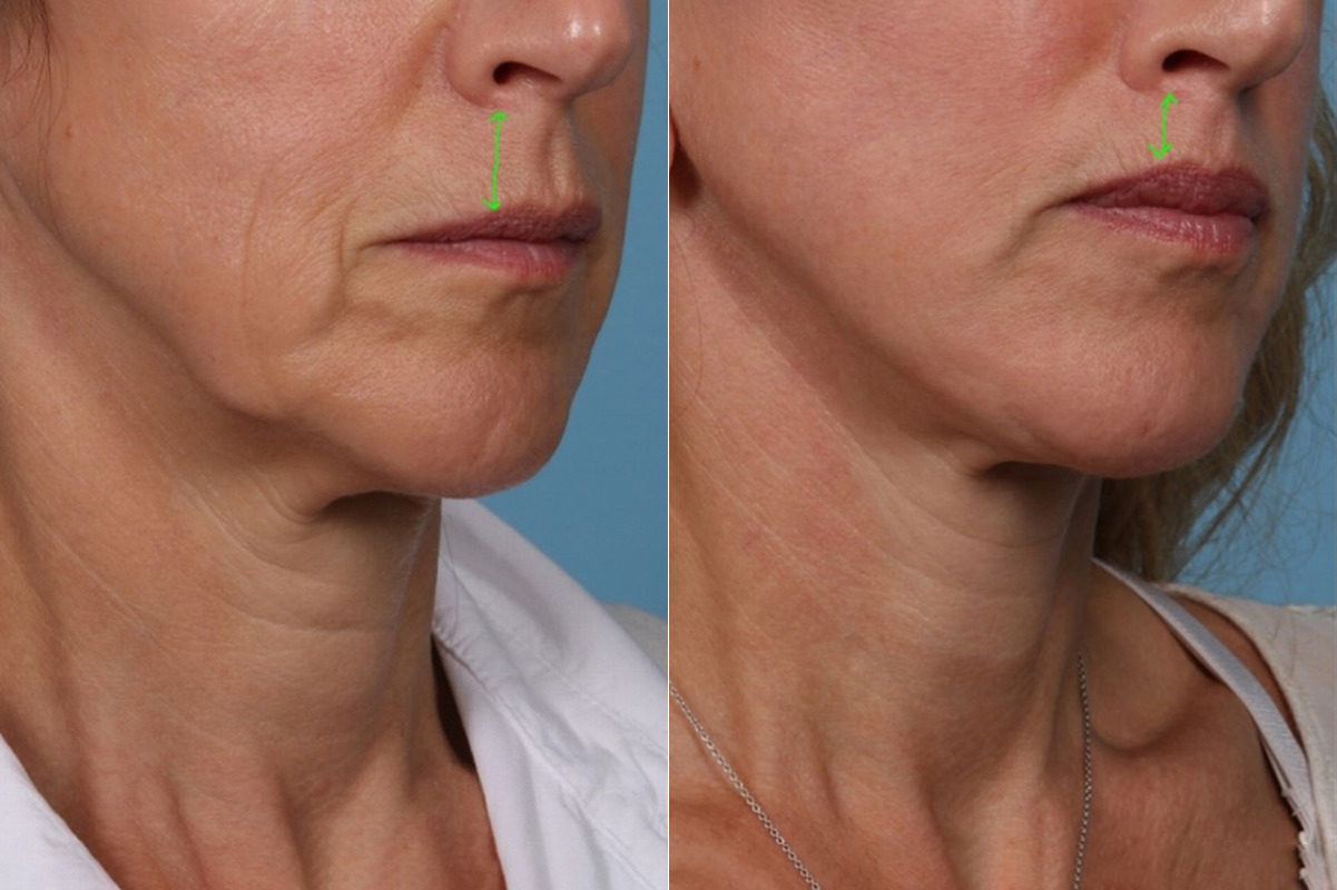 Face lift & Neck lift Before and After Photos in Newburgh, NY, Patient 22168