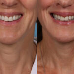 Face lift & Neck lift Before and After Photos in Newburgh, NY, Patient 22168