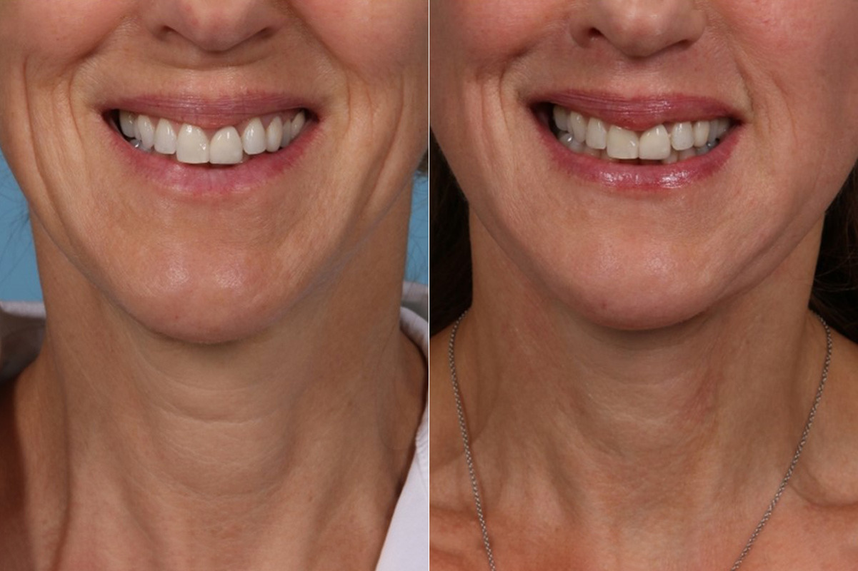 Face lift & Neck lift Before and After Photos in Newburgh, NY, Patient 22168