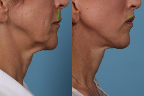 Face lift & Neck lift Before and After Photos in Newburgh, NY, Patient 22168