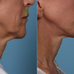 Lip Lift Before and After Photos in Newburgh, NY, Patient 22196