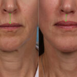 Lip Lift Before and After Photos in Newburgh, NY, Patient 22196