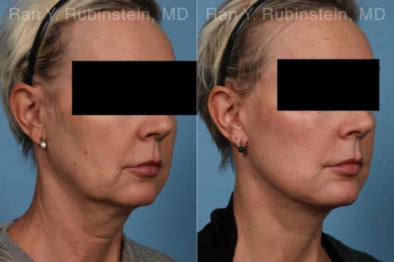 Face lift & Neck lift Before and After Photos in Newburgh, NY, Patient 22249