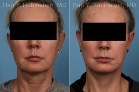 Face lift & Neck lift Before and After Photos in Newburgh, NY, Patient 22249