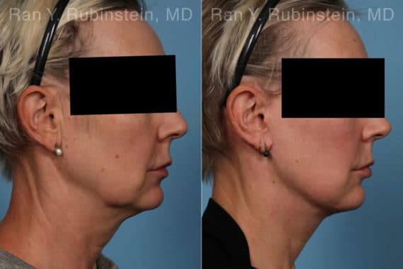 Face lift & Neck lift Before and After Photos in Newburgh, NY, Patient 22249