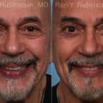 Eyelid Surgery Before and After Photos in Newburgh, NY, Patient 22338