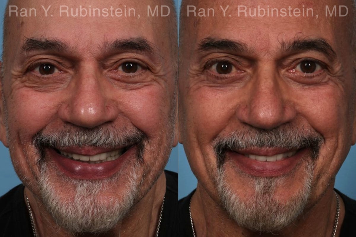 Eyelid Surgery Before and After Photos in Newburgh, NY, Patient 22338