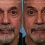 Eyelid Surgery Before and After Photos in Newburgh, NY, Patient 22338