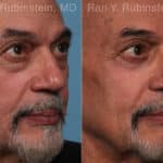 Eyelid Surgery Before and After Photos in Newburgh, NY, Patient 22338