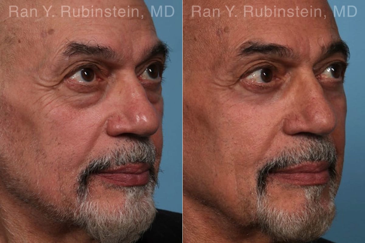 Eyelid Surgery Before and After Photos in Newburgh, NY, Patient 22338