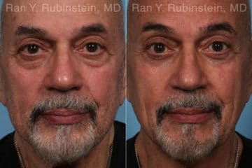 Eyelid Surgery Before and After Photos in Newburgh, NY, Patient 22338