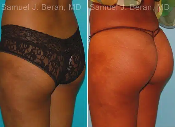 Brazilian Butt Lift Before & After Photos