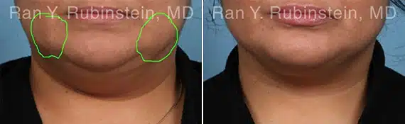 Buccal Fat Removal Before & After Photos