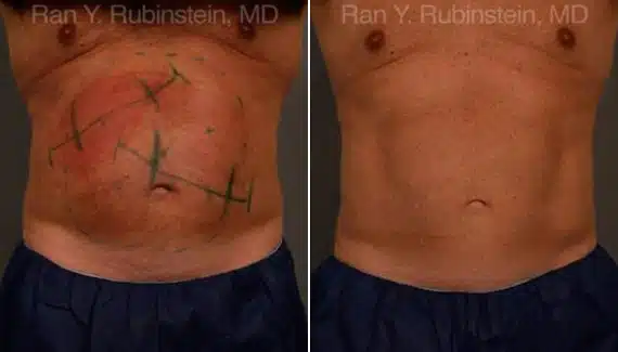 Coolsculpting Elite Before & After Photos