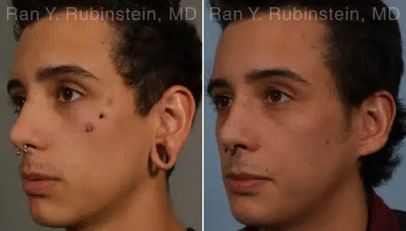 Earlobe Repair Before & After Photos