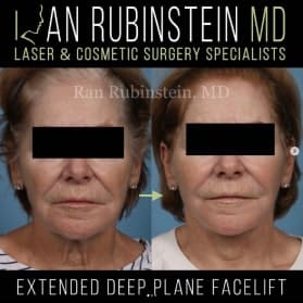 Cosmetic Facial Plastic Surgeon Dr. Ran Y. Rubinstein