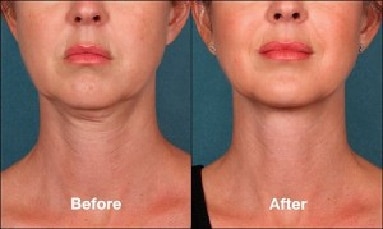 Kybella™ Injectable Before and After Pictures | New York