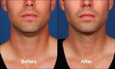 Kybella™ Injectable Before and After Pictures | New York