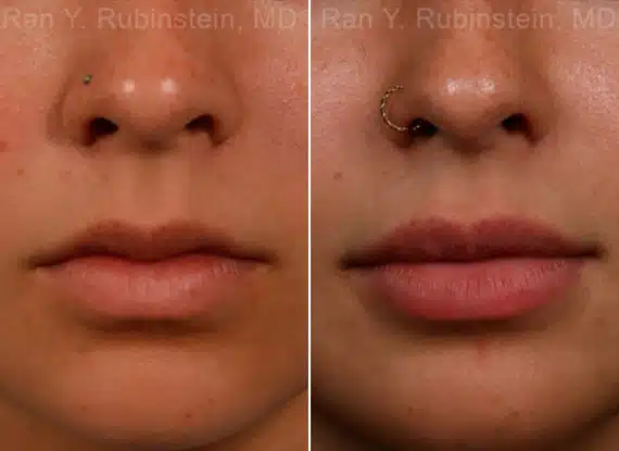 Lip Fillers Before & After Photos