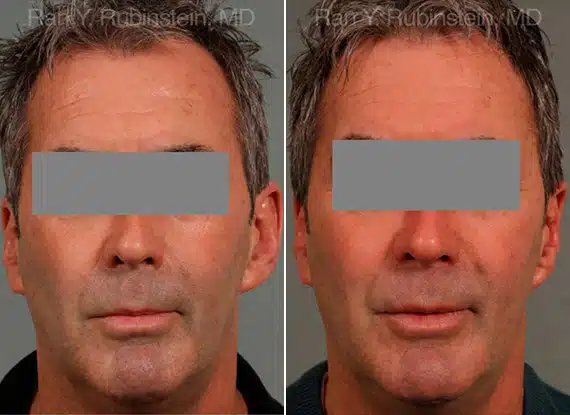 Otoplasty Before & After Photos