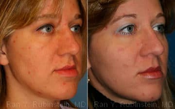 Cheek Augmentation Before and After Photos in Newburgh, NY, Patient 12376