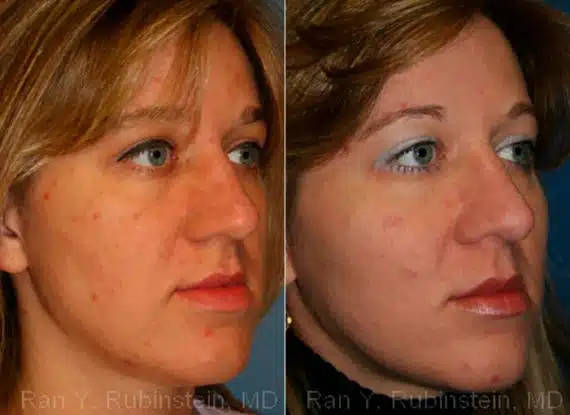 Cheek Augmentation Before & After Photos