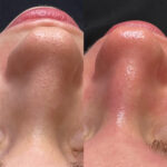 HydraFacial Before and After Photos in Newburgh, NY, Patient 23011