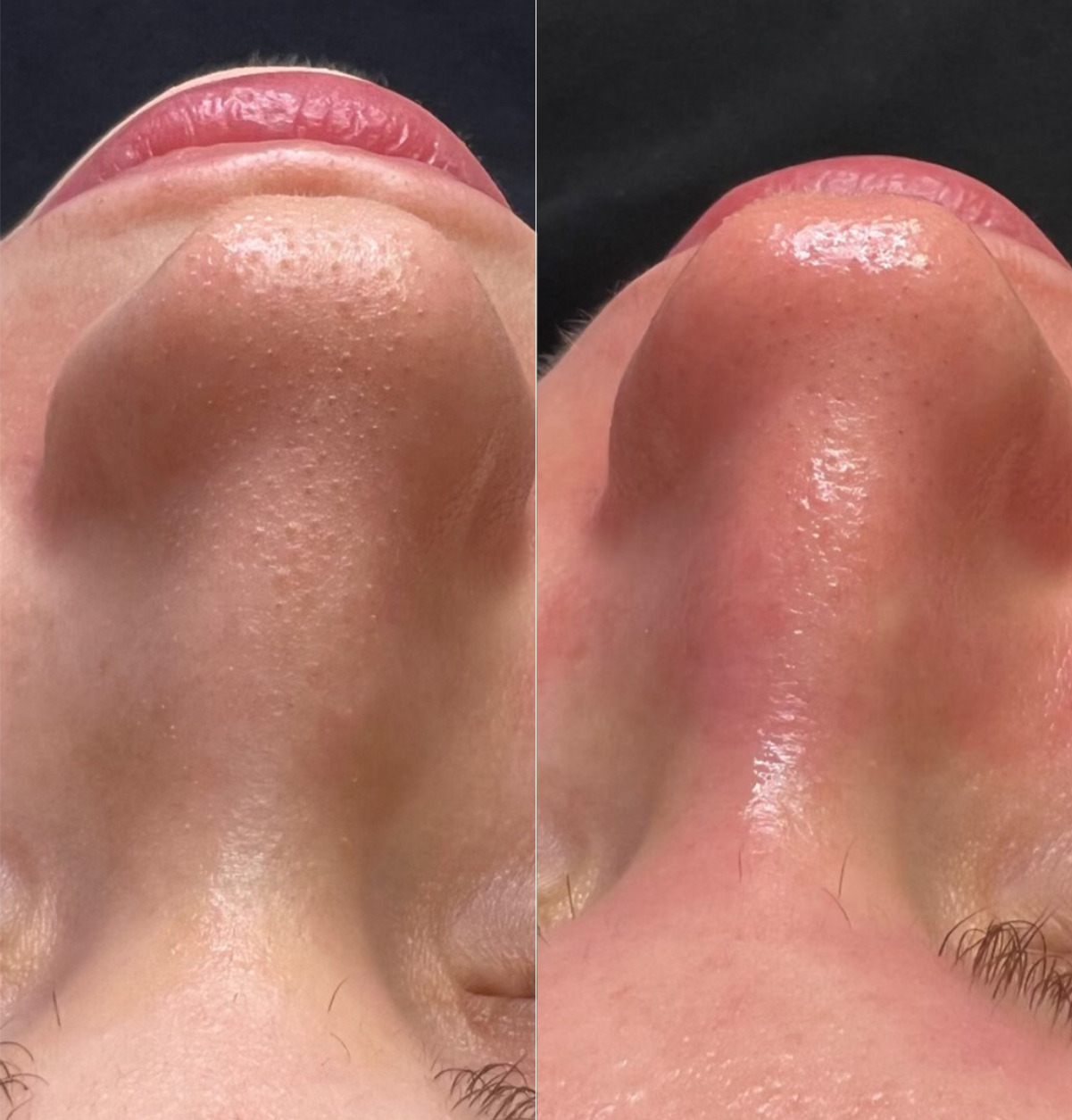 HydraFacial Before and After Photos in Newburgh, NY, Patient 23011