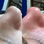 HydraFacial Before and After Photos in Newburgh, NY, Patient 23011