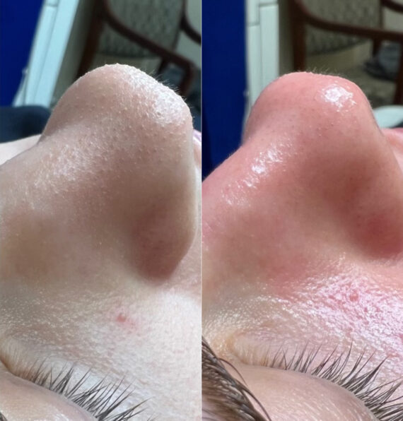 HydraFacial Before and After Photos in Newburgh, NY, Patient 23011