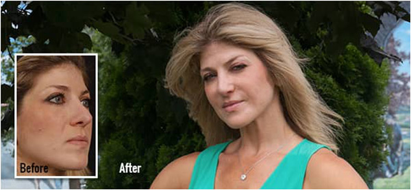 Meet Camille | Revision Rhinoplasty