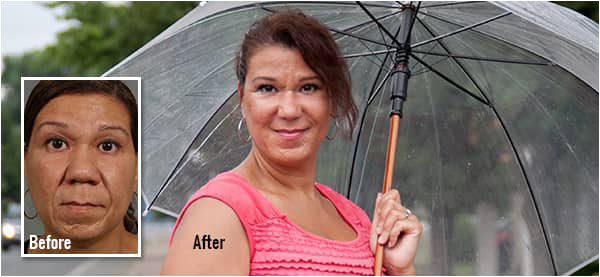 Meet Elsie | Ethnic Rhinoplasty