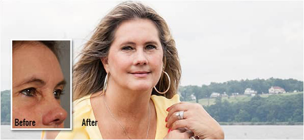 Meet Bridget | Upper Blepharoplasty