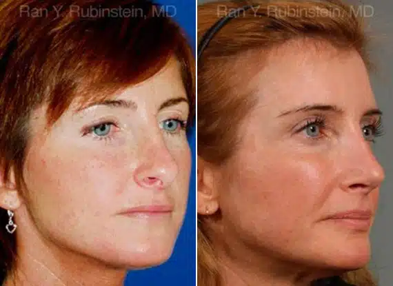 Rhinoplasty Revision Before & After Photos