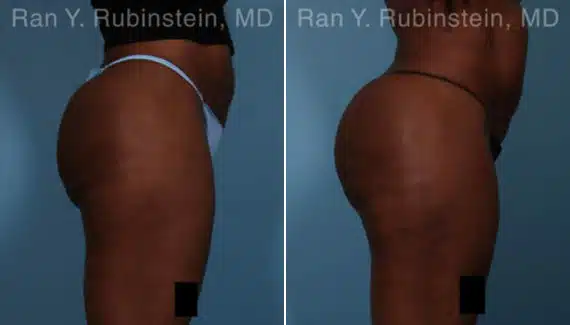 Sculptra Butt Lift Before & After Photos