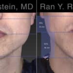 Chin Augmentation Before and After Photos in Newburgh, NY, Patient 23272