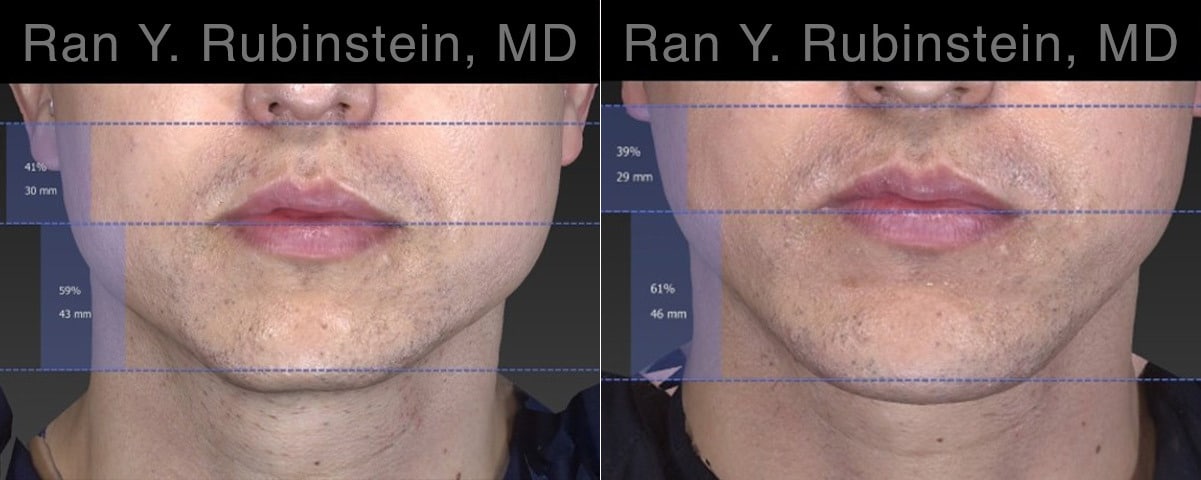 Chin Augmentation Before and After Photos in Newburgh, NY, Patient 23272