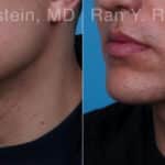 Chin Augmentation Before and After Photos in Newburgh, NY, Patient 23272