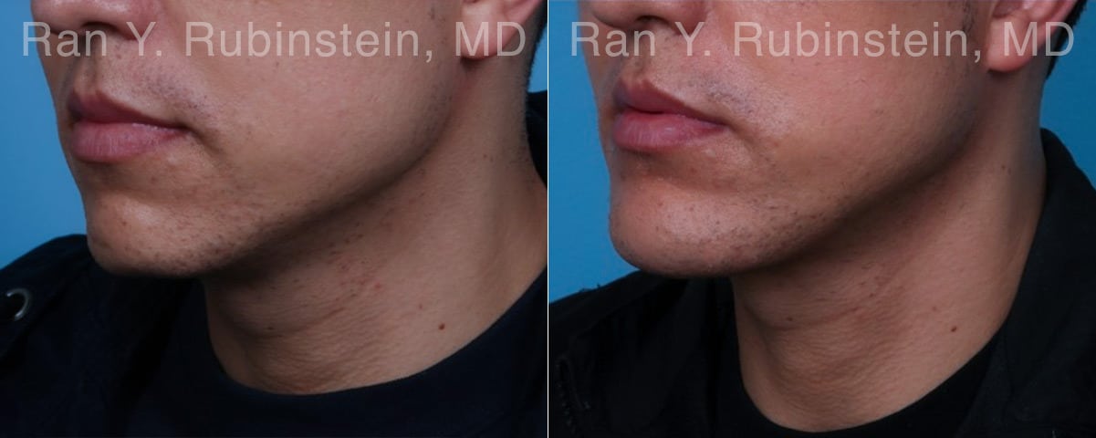 Chin Augmentation Before and After Photos in Newburgh, NY, Patient 23272