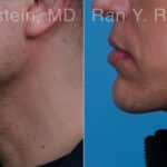 Chin Augmentation Before and After Photos in Newburgh, NY, Patient 23272