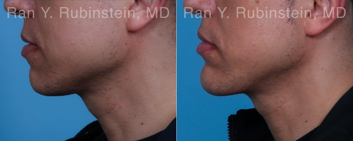 Chin Augmentation Before and After Photos in Newburgh, NY, Patient 23272