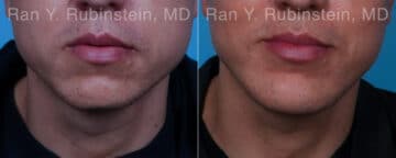 Chin Augmentation Before and After Photos in Newburgh, NY, Patient 23272