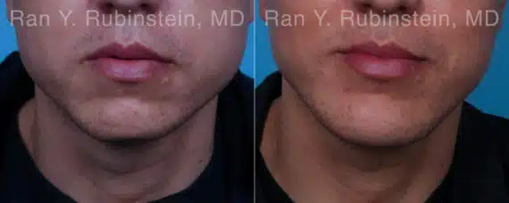 Chin Augmentation Before and After Photos in Newburgh, NY, Patient 23272